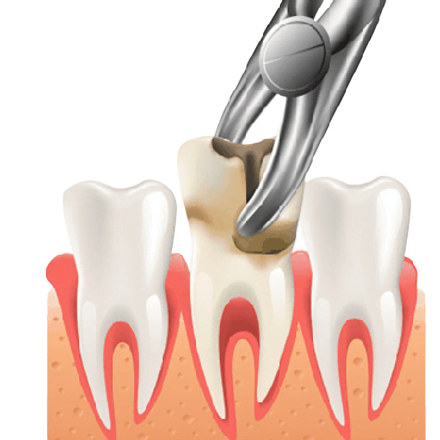 Surgical Tooth Extraction In Dubai - Sejovi Dental & Implant Center