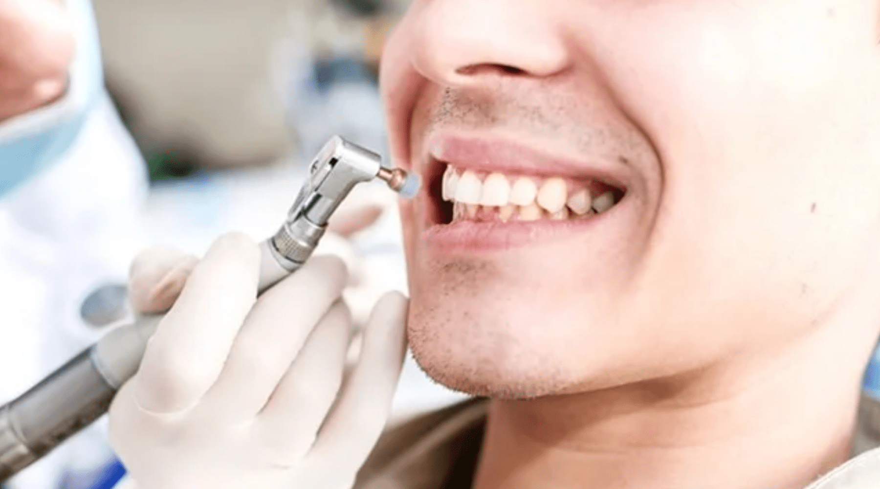 Know About Teeth Scaling And Teeth Polishing Sejovi Dental And Implant Center Dubai